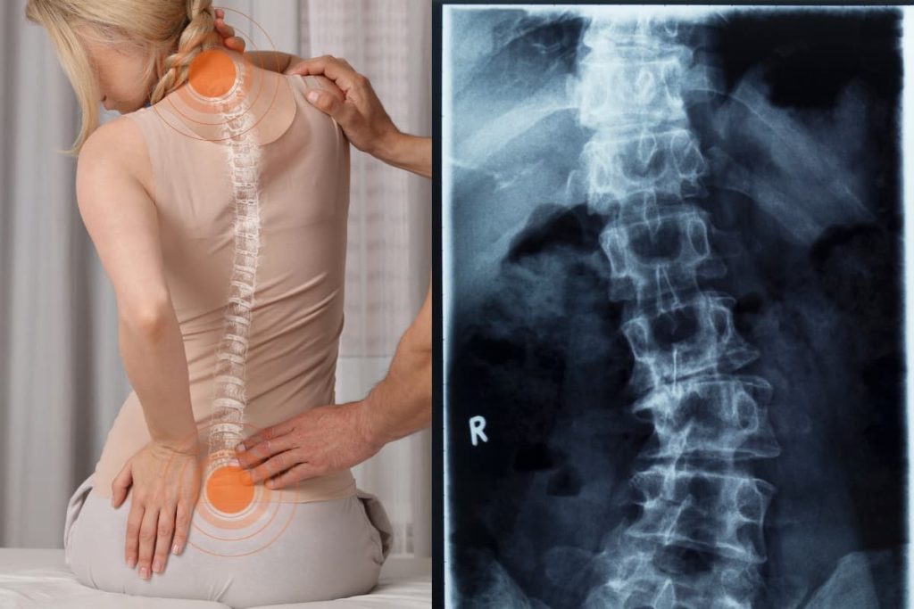 Skolyoz (Omurga Eğriliği) Olan Kadın ve Röntgen Sonuçları